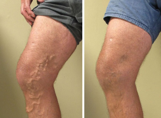 avant et après la chirurgie